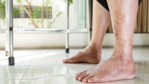 signs of diabetes