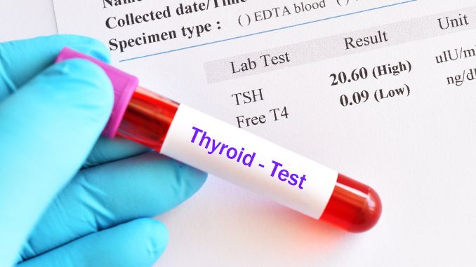 Exploring Additional Lab Tests for a Comprehensive Assessment of Hypothyroidism