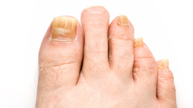 Understanding the Signs: How to Know if Toenail Fungus is Dying?