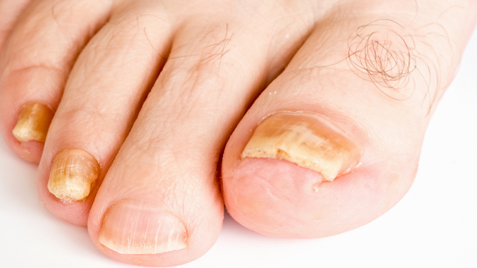 symptoms of toenail fungus - how to know if toenail fungus is dying