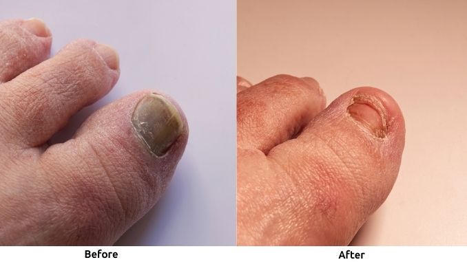 toenail-regrowing - how to know if toenail fungus is dying