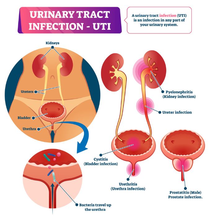 urinary-tract-infection - How Rapid is Weight Loss with Farxiga