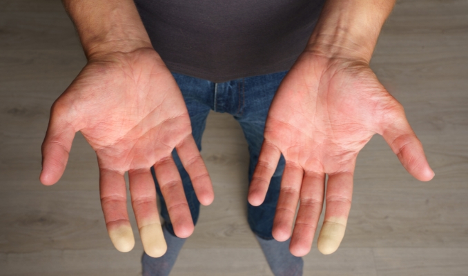 Raynaud's Syndrome Test and Diagnosis
