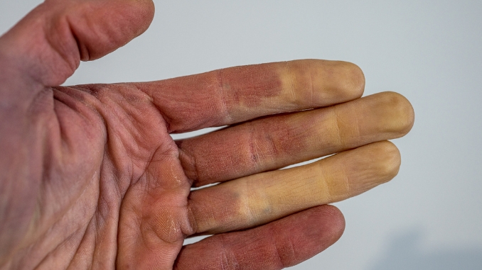 Raynaud's Syndrome Test