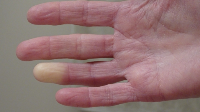 What is Raynaud's Syndrome